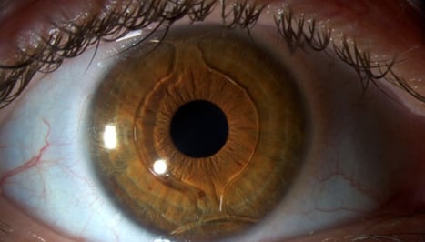 son las cirugías con las se puede arreglar la vista cansada?