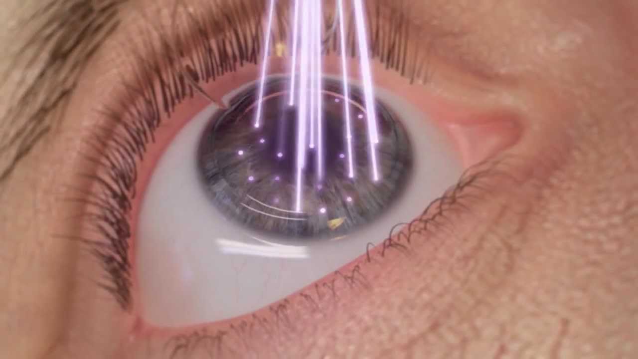 Cerco Antagonista Tomate Qué tipos de cirugías oculares existen?