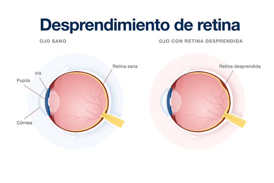 Desprendimiento-de-retina