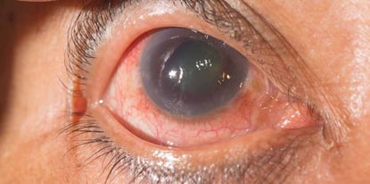 que-es-glaucoma-clinica-internacional-950x472
