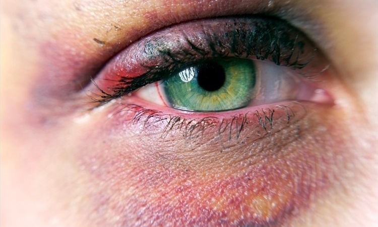 Sufrí un golpe en el ojo, ¿en qué momento debo de ir al doctor?